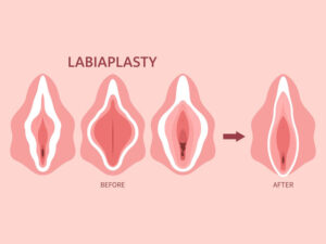 DR. UB RAO – BEST GENITAL AESTHETIC & PLASTIC SURGEON 18 LABIAPLASTY