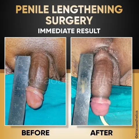Ligament Lysis (Suspensory Ligament Release) 4 Penile Lengthening