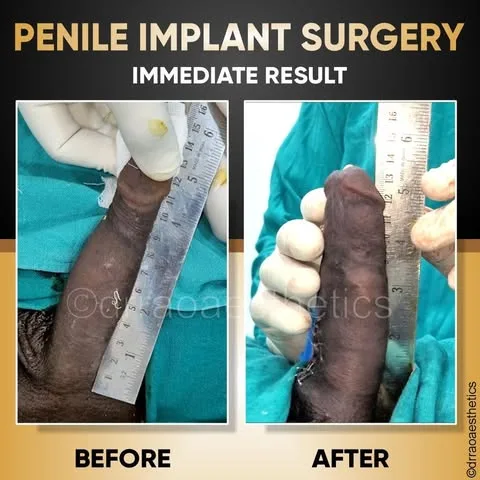 Penile Implant