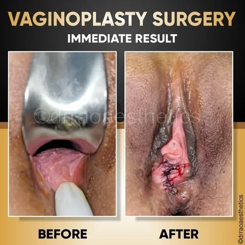 Vaginal Tightening 1 Vaginal Tightening