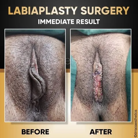 Labiaplasty 1 Labiaplasty