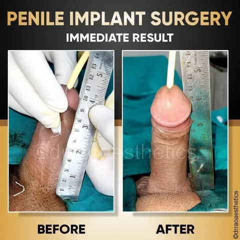 Penile Implant