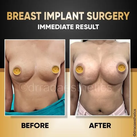 Breast Implant 1 Breast Implant