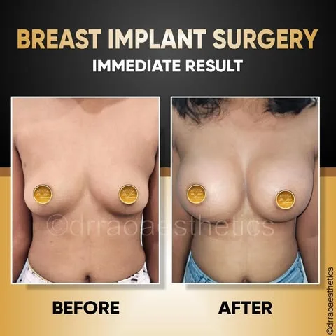 Breast Implant 2 487074816 1612634016099788 871264280191321767 n 1