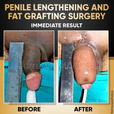 MALE SURGERIES 1 Penile Lenghtening and Fat Grafting