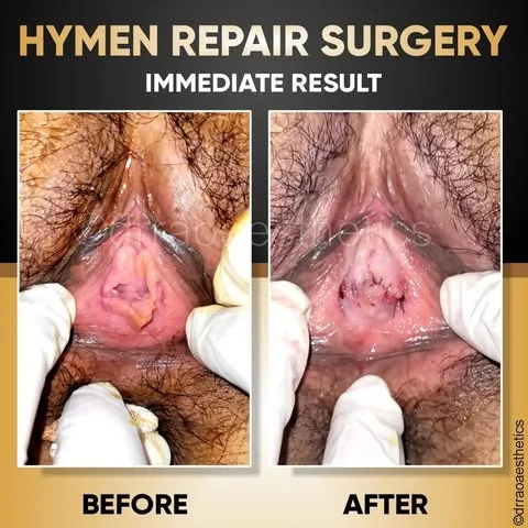 Hymenoplasty 1 Hymenoplasty