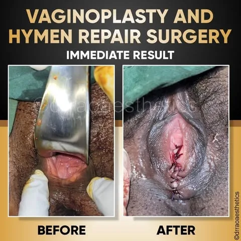 Female Surgeries 2 Vaginoplasty and Hymen Repair