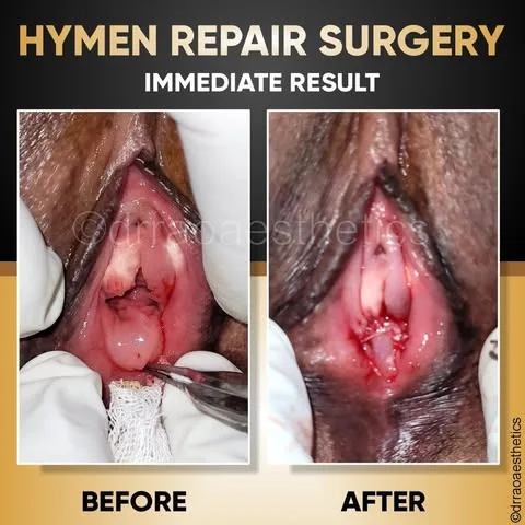 Hymenoplasty 2 Hymenoplasty