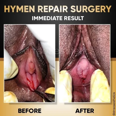 Hymenoplasty 3 Hymenoplasty