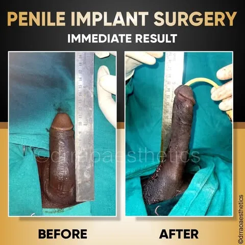 Penile Implant