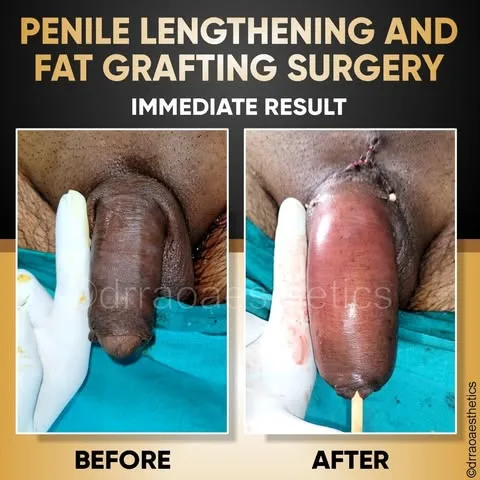 MALE SURGERIES 3 Penile Lenghtening and Fat Grafting