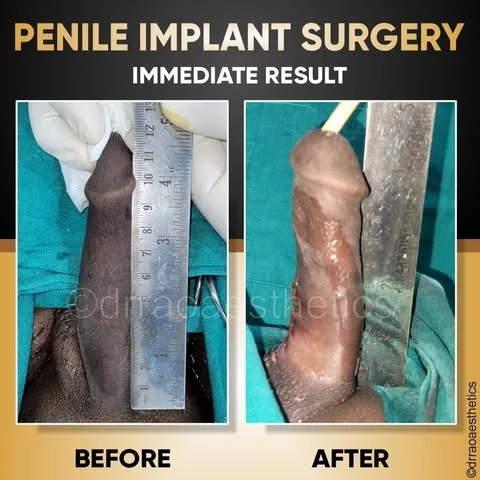 Penile Implant