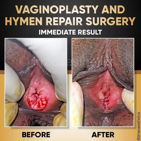 Female Surgeries 3 Vaginoplasty and Hymen Repair