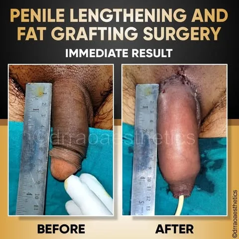 MALE SURGERIES 5 Penile Lenghtening and Fat Grafting