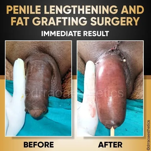 MALE SURGERIES 4 Penile Lenghtening and Fat Grafting