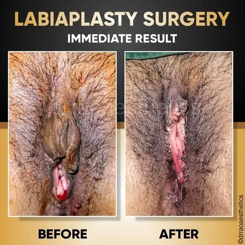 Labiaplasty 2 Labiaplasty